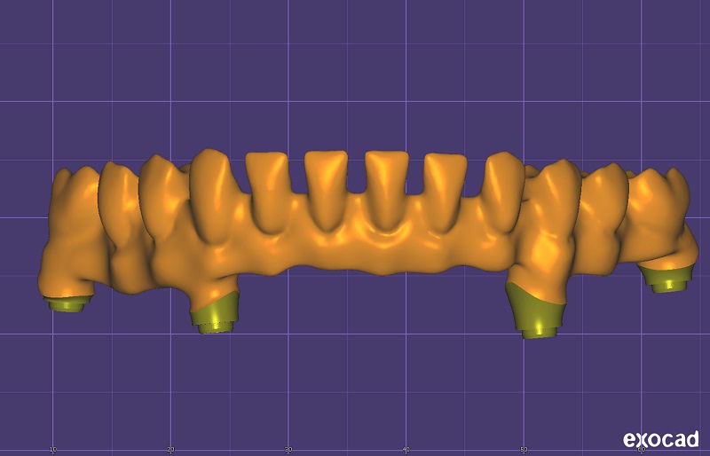 CAD project- prosthesis